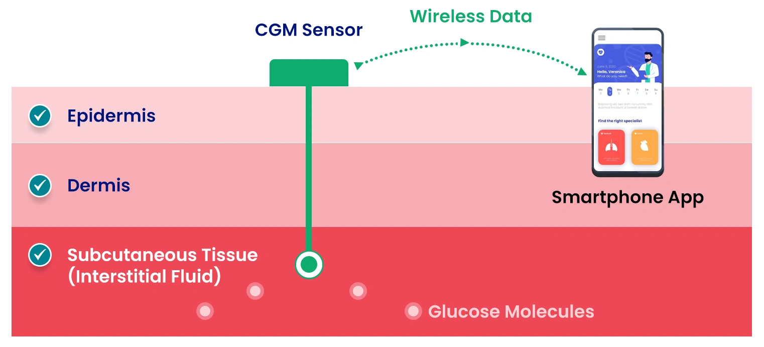 Illustration showing CGM sensor inserted under skin layers and linked to mobile app for continuous glucose monitoring